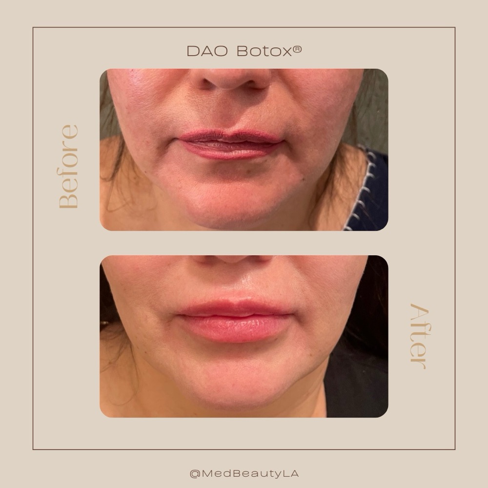 DAO Botox before and after at MedBeautyLA: downturned corners of the mouth lifted and softened