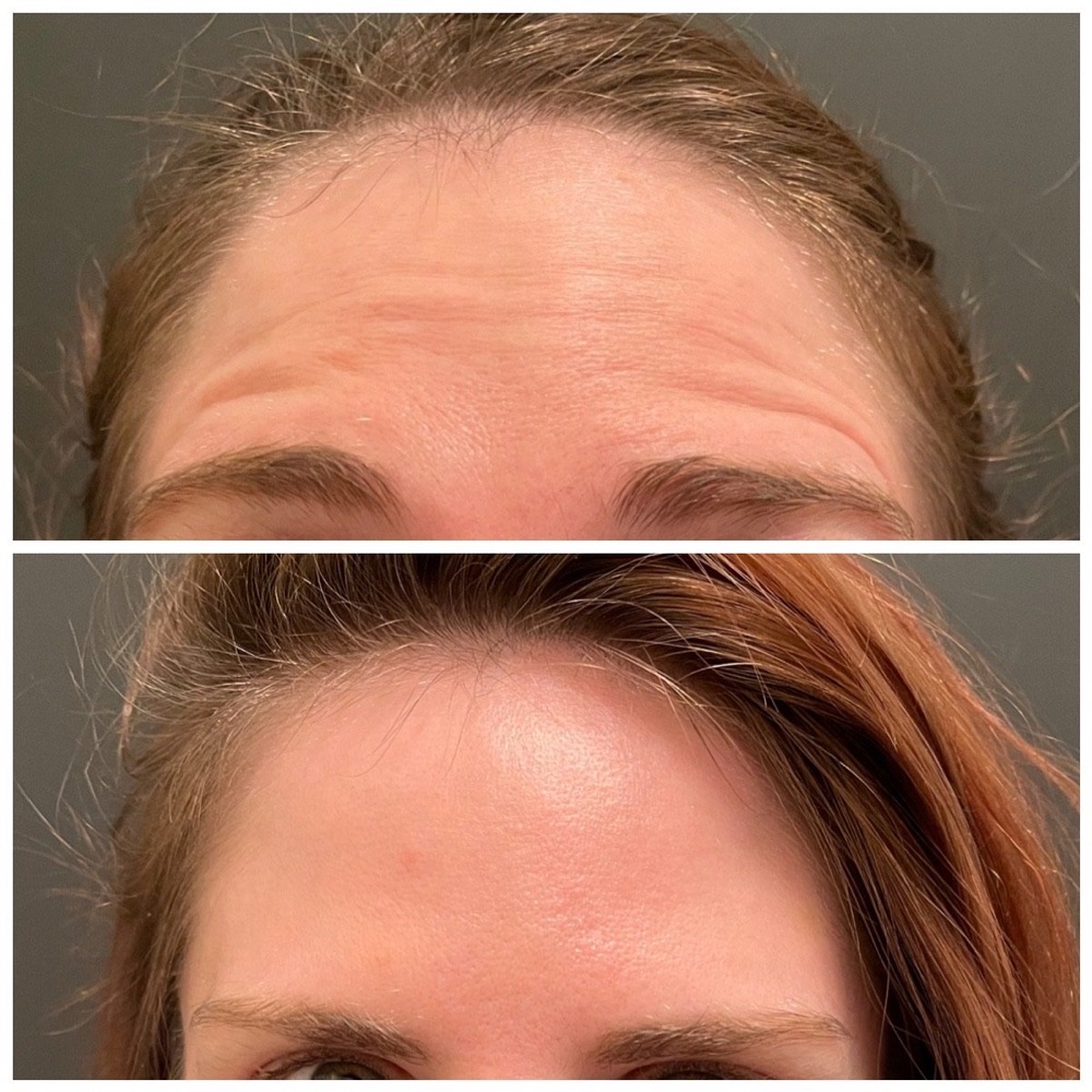 Daxxify before and after at MedBeautyLA: a woman's forehead lines before treatment (top) and visibly smoother three days after (bottom)