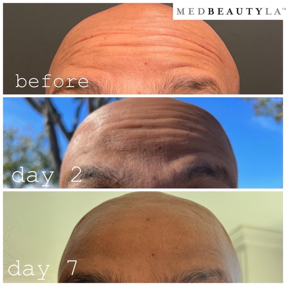 Daxxify results at MedBeautyLA: a man's deep forehead lines before treatment, softening by day 2 and smooth by day 7