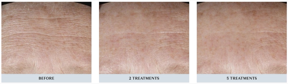 DiamondGlow facial before, after two and after five treatments: forehead lines and crepey texture progressively smoother