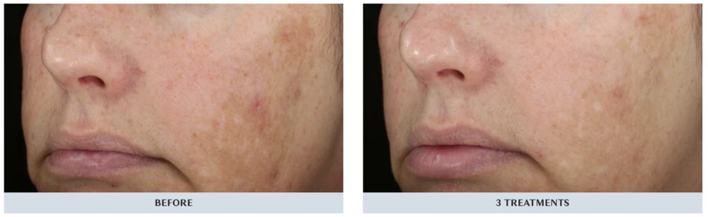 DiamondGlow facial before and after three treatments: brown spots and redness on the cheek visibly lighter and more even