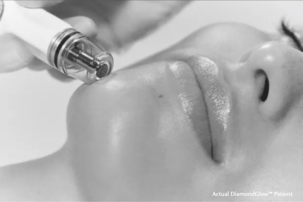 Close-up of the DiamondGlow wand with its diamond tip passing over a patient's chin during a facial