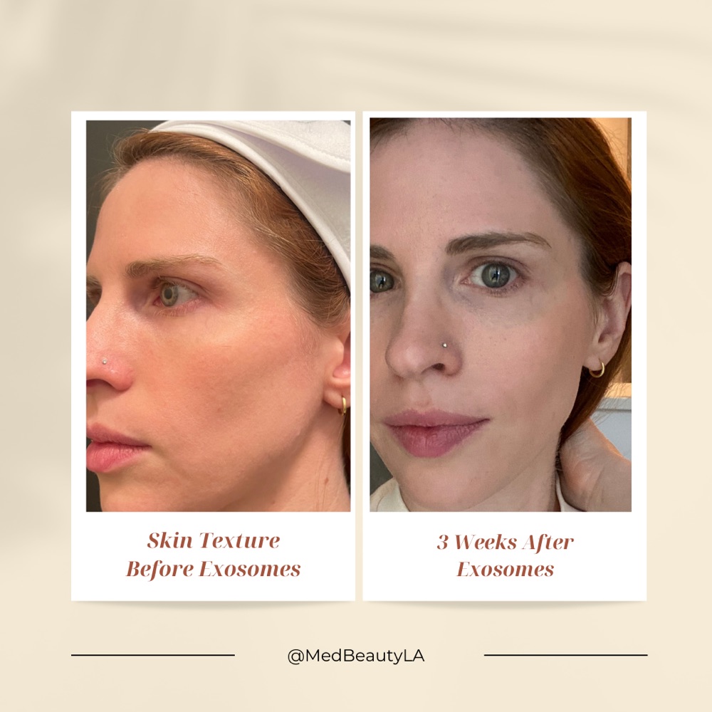 MedBeautyLA client before exosomes and three weeks after exosomes, with smoother, more even skin texture on the cheek and forehead