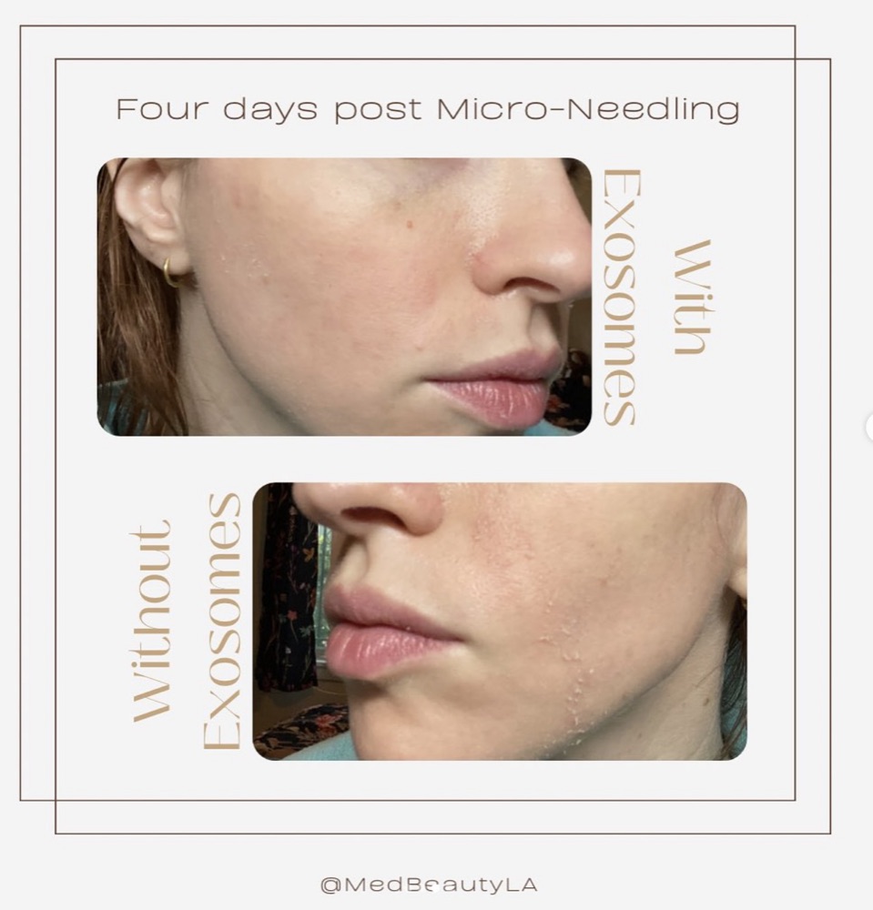 Four days after microneedling, the cheek treated with exosomes is smooth while the cheek without exosomes is still flaking