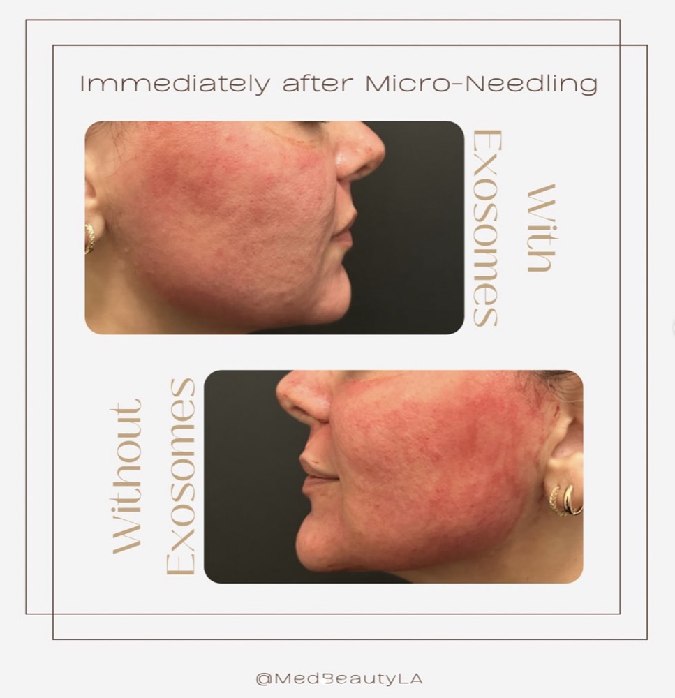 Immediately after microneedling, the side of the face treated with exosomes is visibly less red than the side treated without exosomes