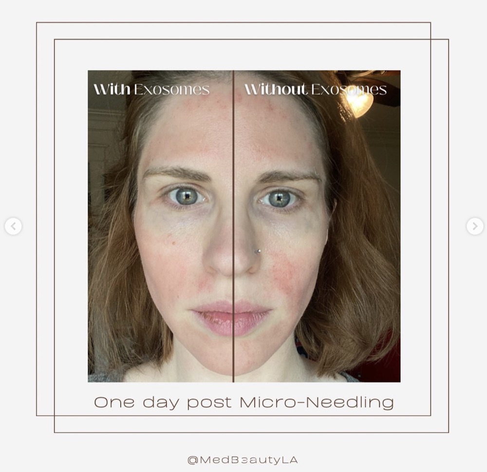 Split-face photo one day after microneedling: the half treated with exosomes shows less redness than the half without