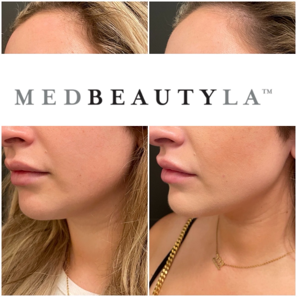 Facial balancing before and after at MedBeautyLA: cheeks, jawline and chin treated for a more contoured profile