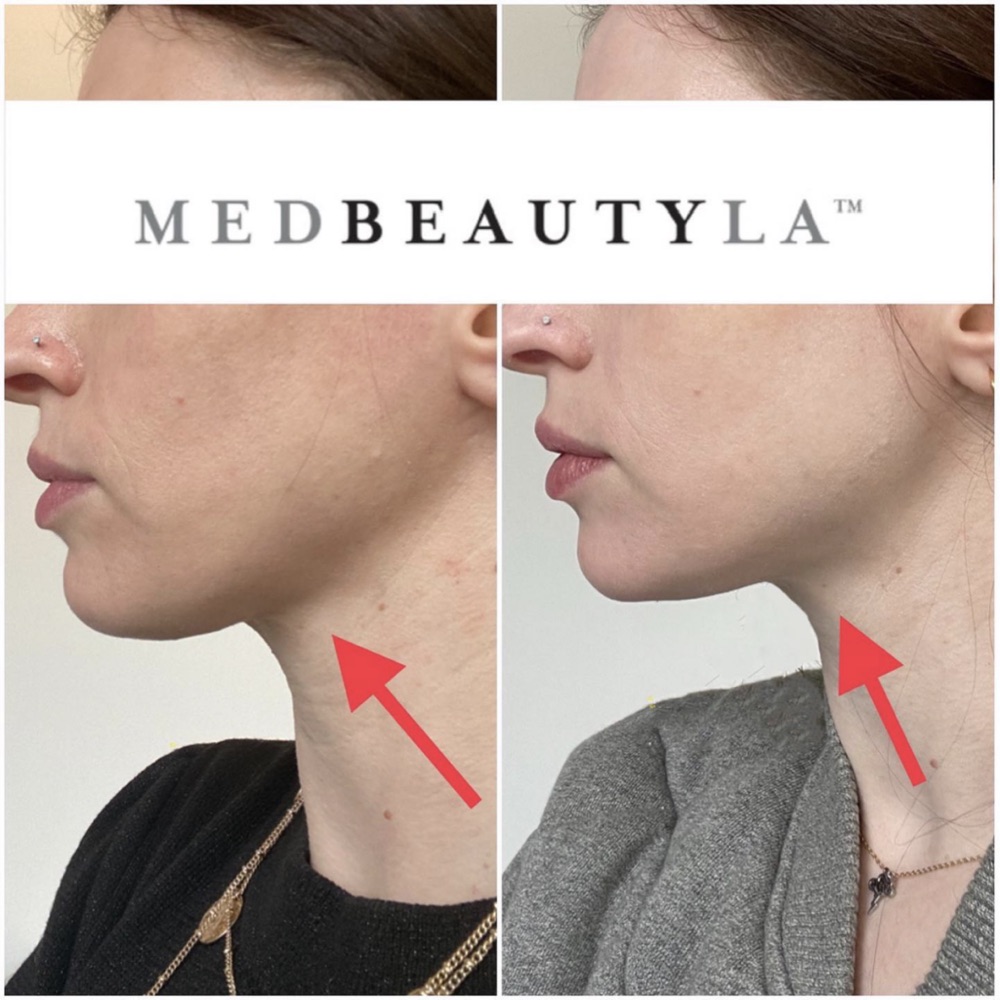 Facial balancing before and after at MedBeautyLA: a more defined jawline and subtly stronger chin in profile
