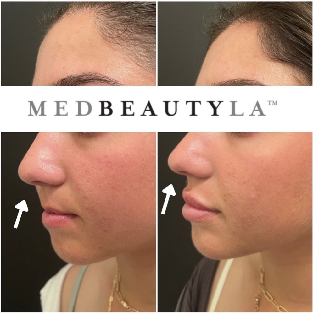 Facial balancing before and after at MedBeautyLA: nose, lip and chin brought into balance in profile
