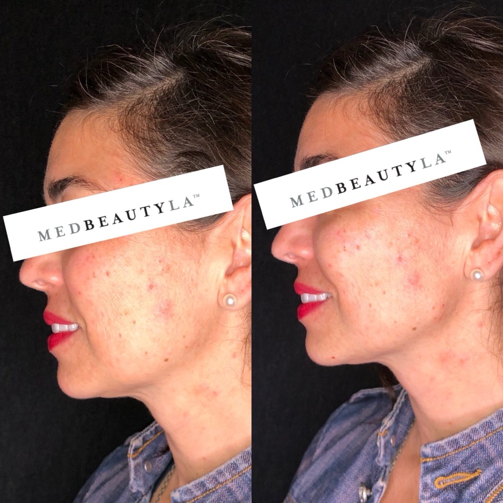 Jawline filler before and after at MedBeautyLA: a sharper, more defined jawline and chin in profile