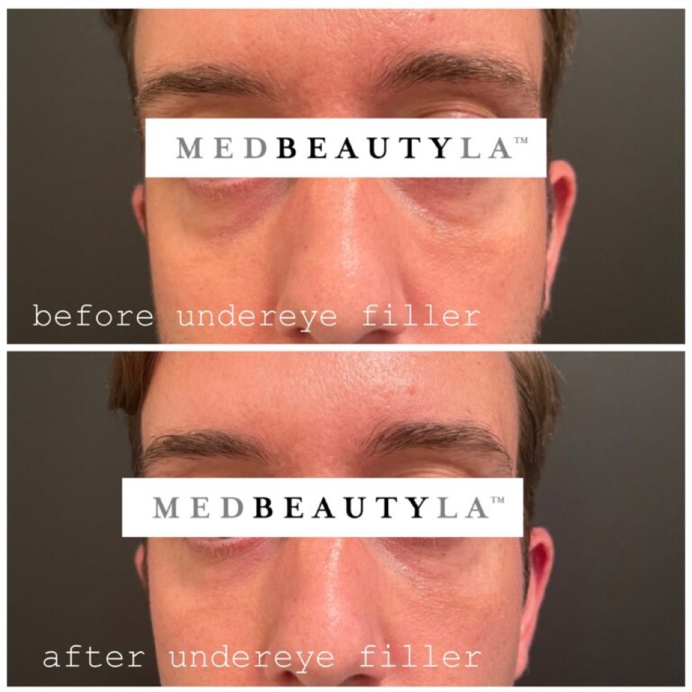Under-eye filler before and after at MedBeautyLA: softened hollows and less shadowing under the eyes