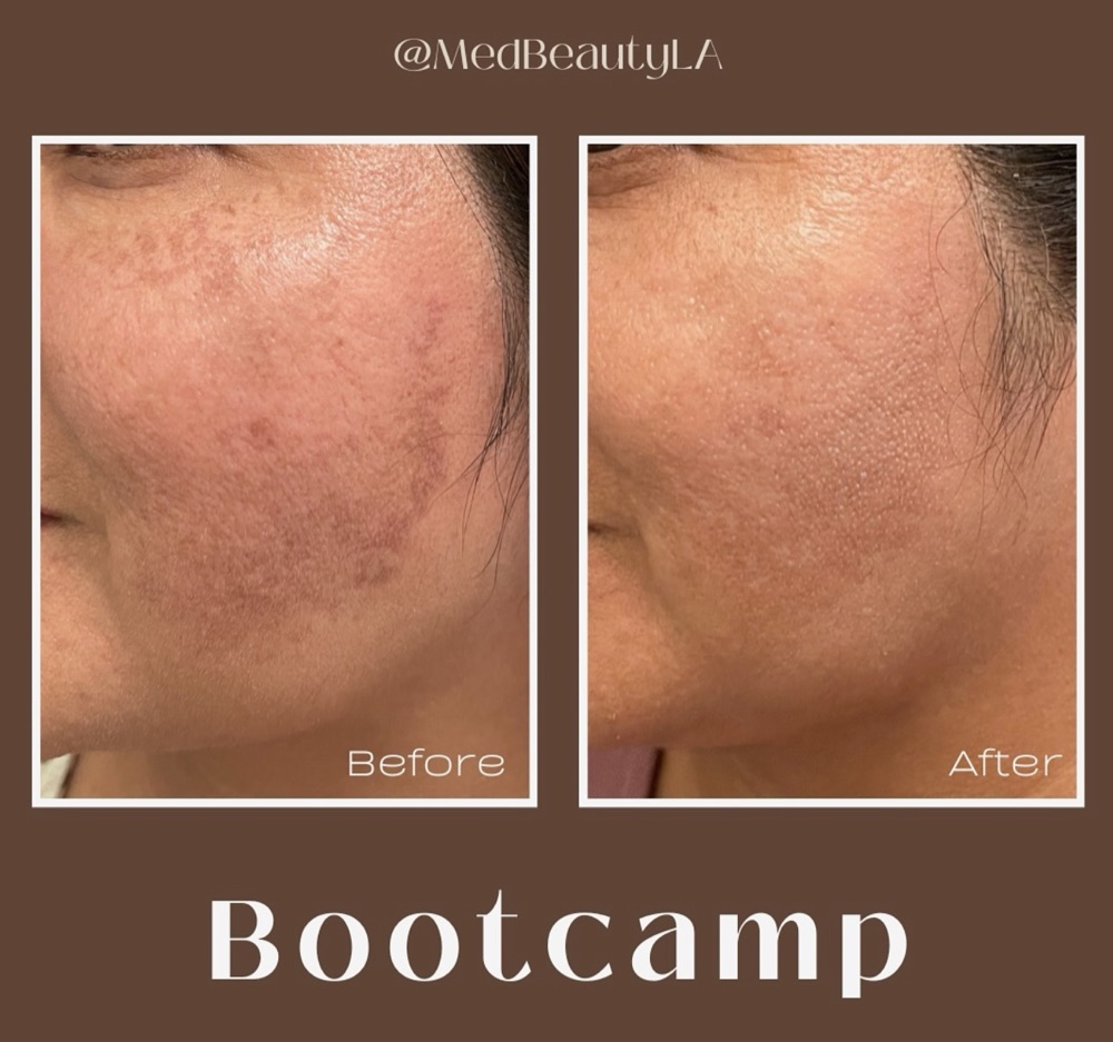Hyperpigmentation Bootcamp before and after at MedBeautyLA: large brown patches on the cheek fade to a much more even tone