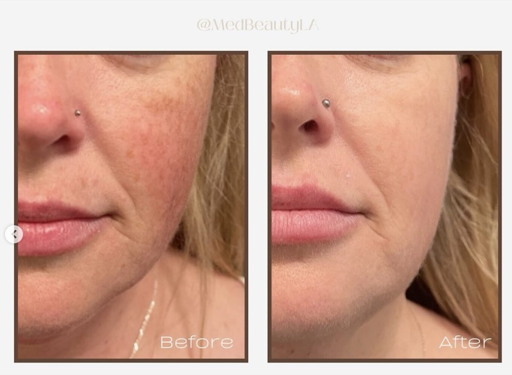 Hyperpigmentation before and after at MedBeautyLA: brown spots and redness on the cheek and nose clear to even-toned skin