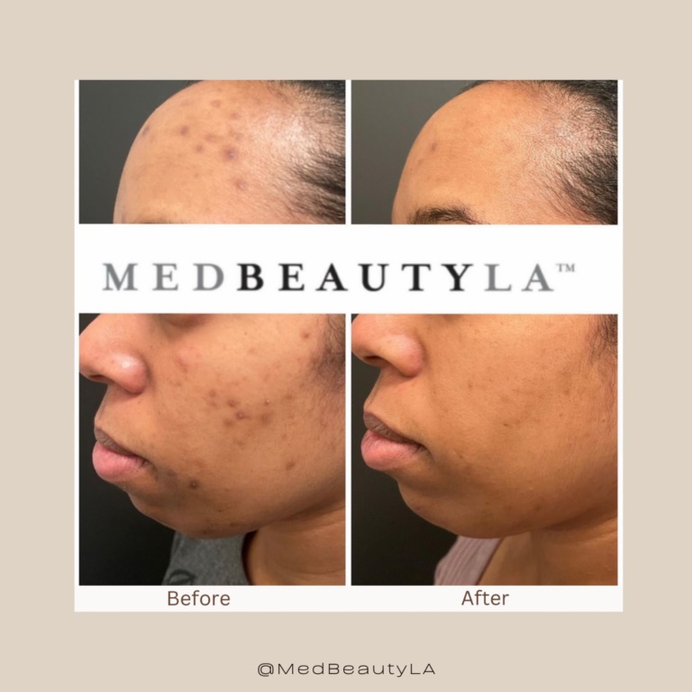 Hyperpigmentation before and after at MedBeautyLA: dark spots left by breakouts on the forehead, cheek and jaw fade noticeably