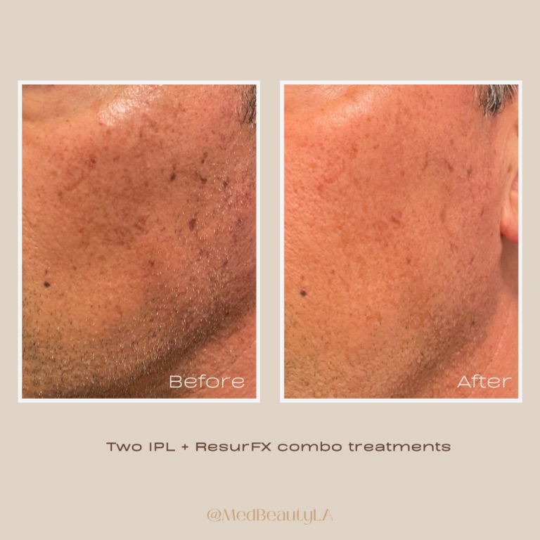 Sun spot before and after at MedBeautyLA: brown spots on a man's cheek fade after two IPL and ResurFX combo treatments
