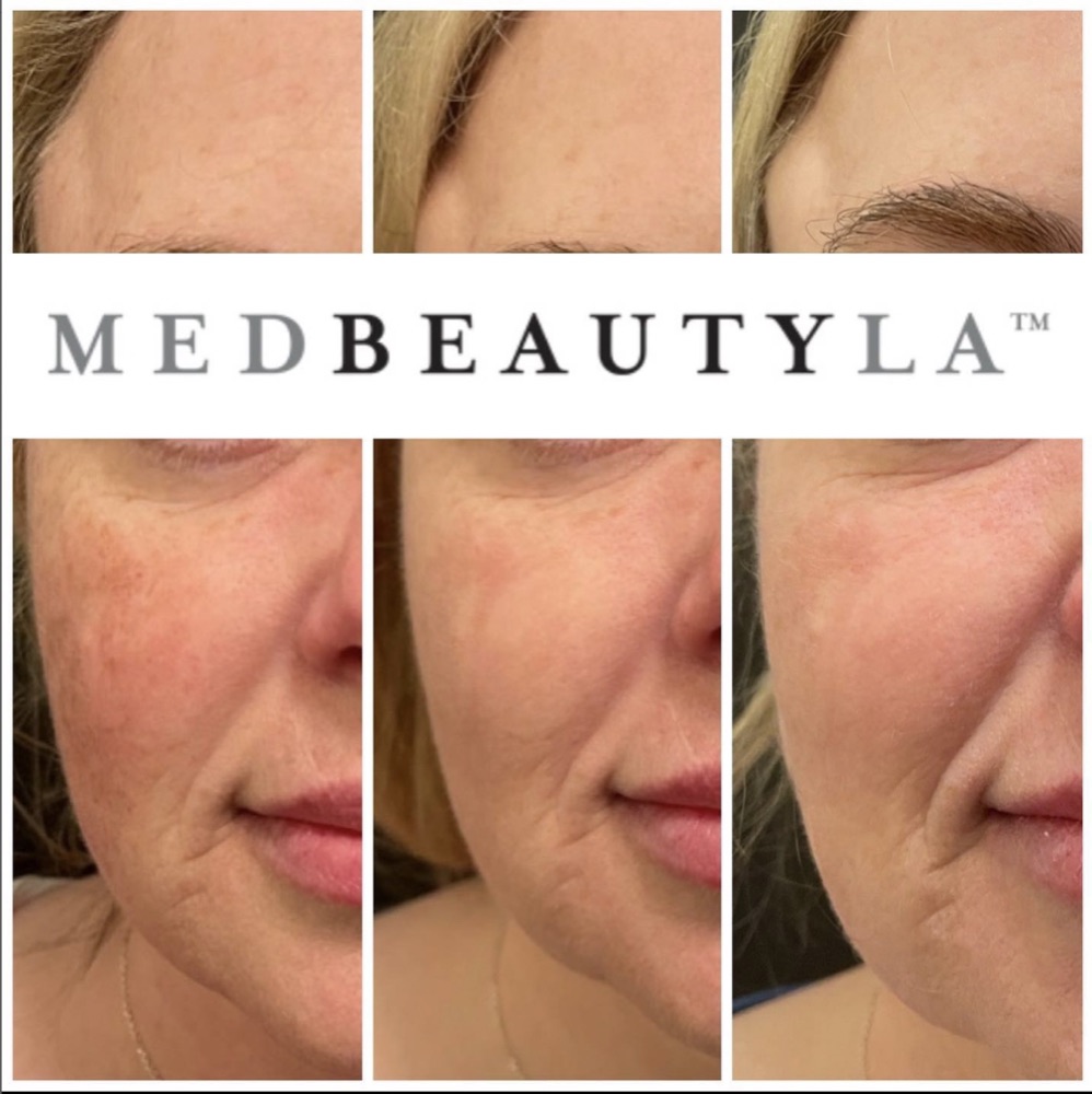 IPL photofacial before and after at MedBeautyLA: redness and brown spots on the cheek fade over two sessions