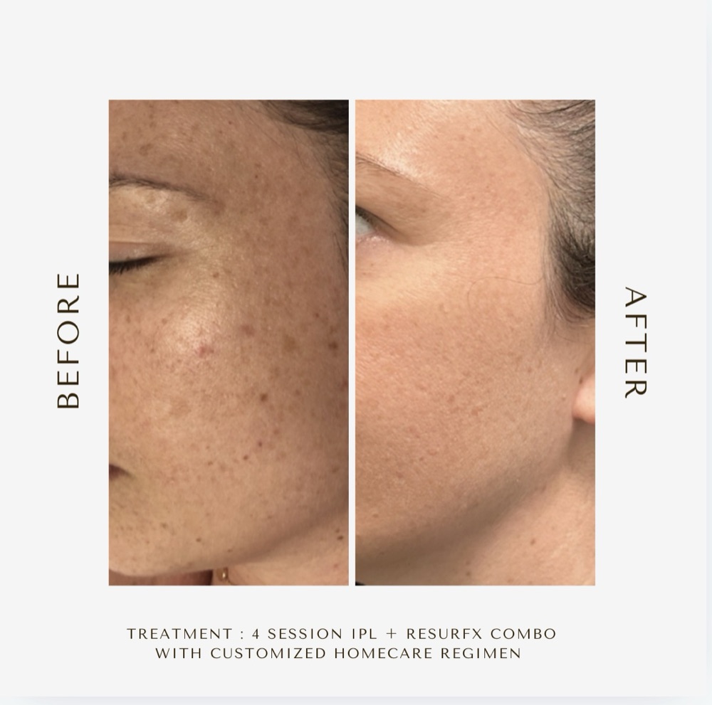 Before and after four IPL and ResurFX combination sessions: freckles and brown spots on the cheek and temple cleared to an even tone