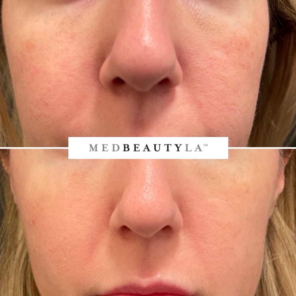 IPL and ResurFX before and after at MedBeautyLA: blotchy redness across the cheeks and nose calmed to an even tone