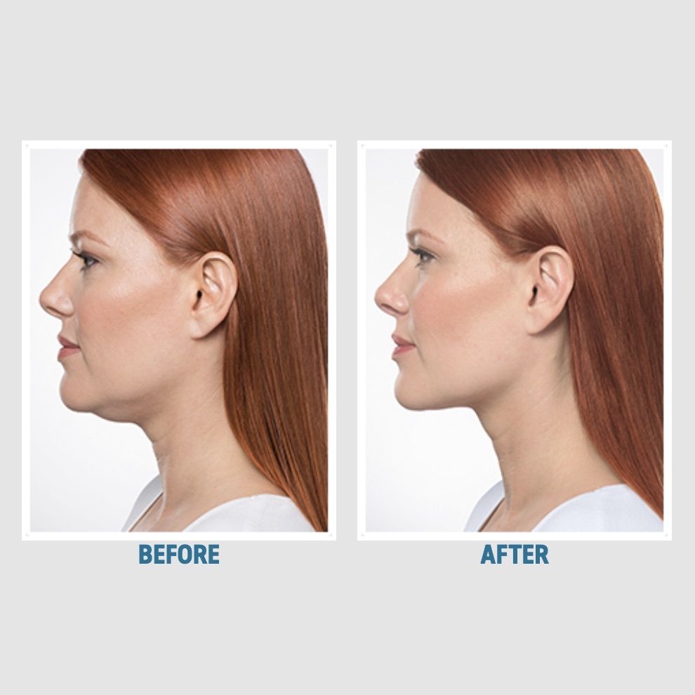 Kybella clinical before and after in profile: a rounded double chin replaced by a smooth jaw-to-neck line