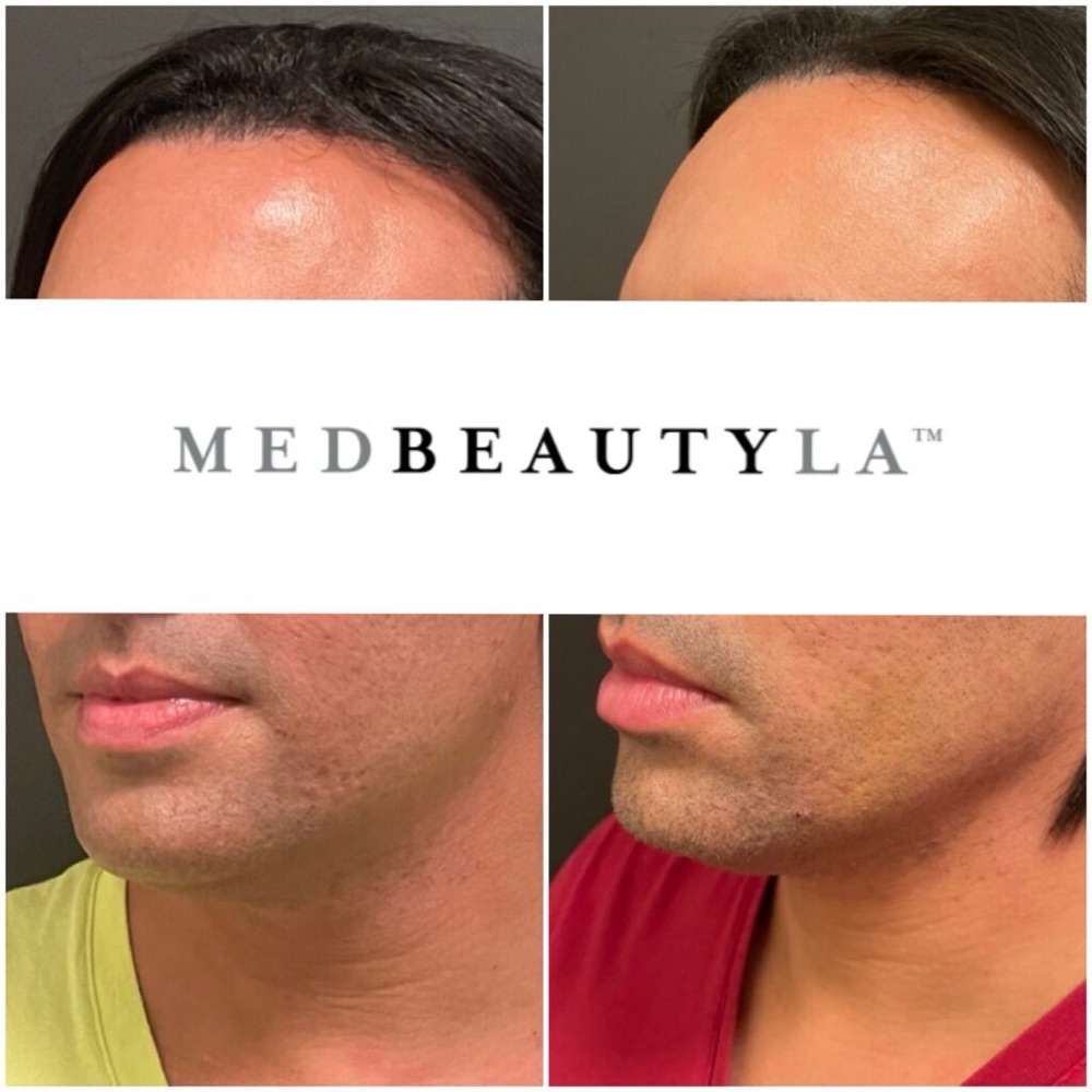 Kybella before and after on a man at MedBeautyLA: less fullness under the chin and a sharper jawline