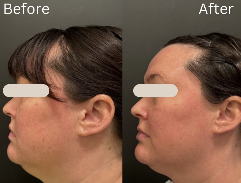 Side profile of the same MedBeautyLA client before and after laser treatment: faded freckles and a clearer, more even complexion