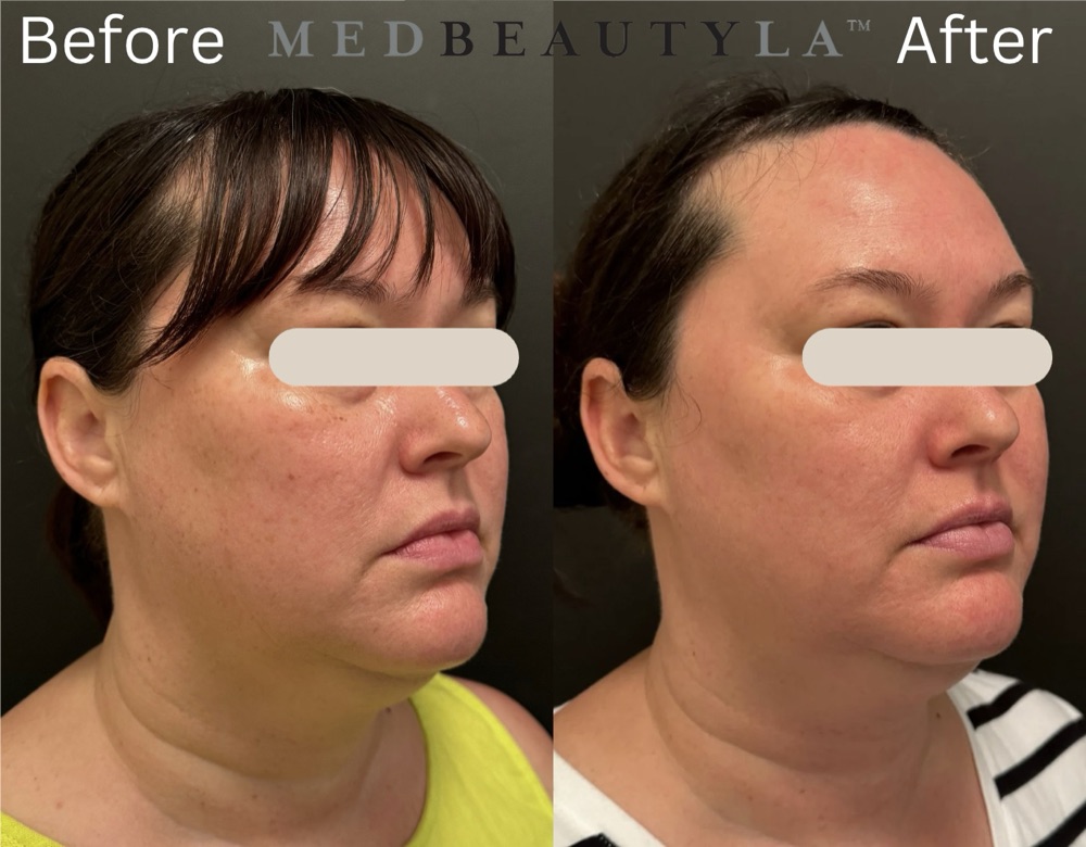 Before and after laser treatment at MedBeautyLA: fewer freckles and brown spots and a more even skin tone across the cheek and jaw