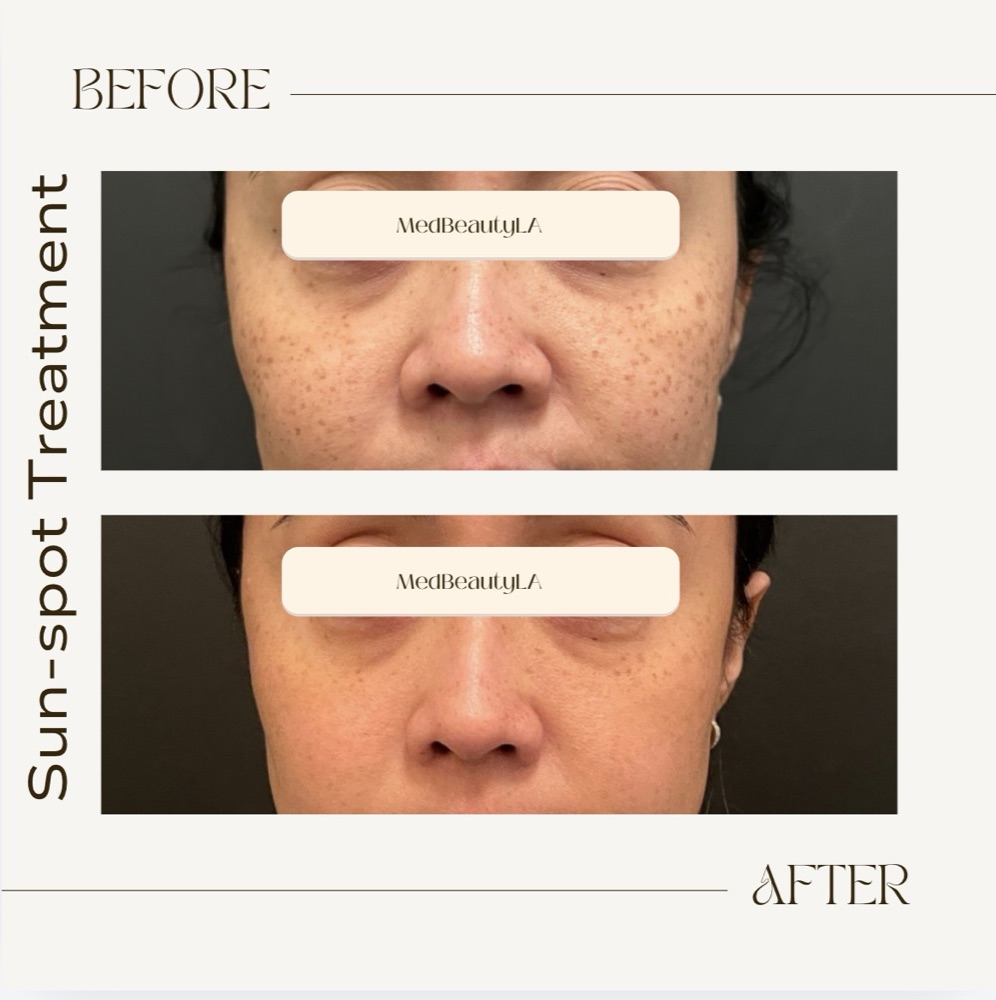 Sun-spot treatment before and after at MedBeautyLA: dense brown sun spots across both cheeks visibly faded