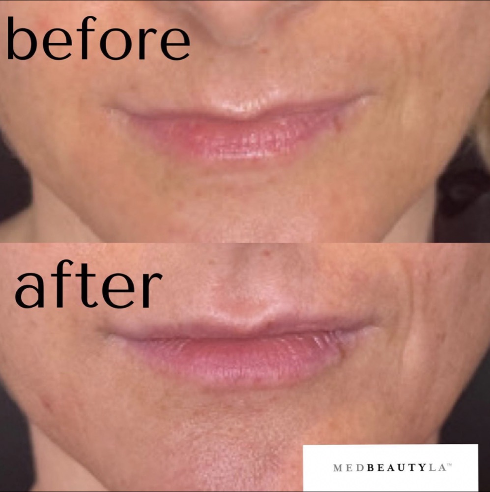 Lip filler before and after from the front: thin lips made fuller with a subtle, natural result