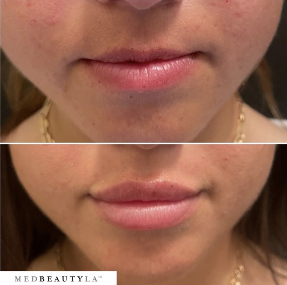 Lip filler before and after from the front: fuller lips with a defined cupid's bow