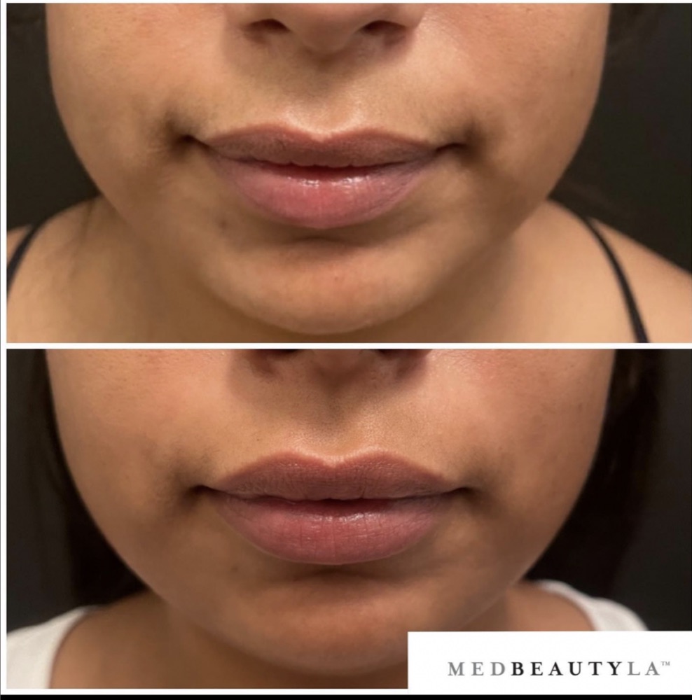 Lip filler before and after at MedBeautyLA: fuller, more even lips from the front with a natural shape