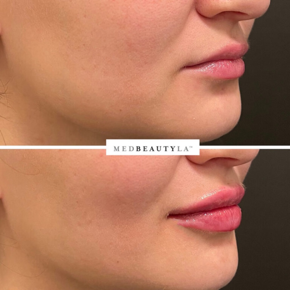 Lip filler before and after in profile: more defined lip border and fuller upper lip