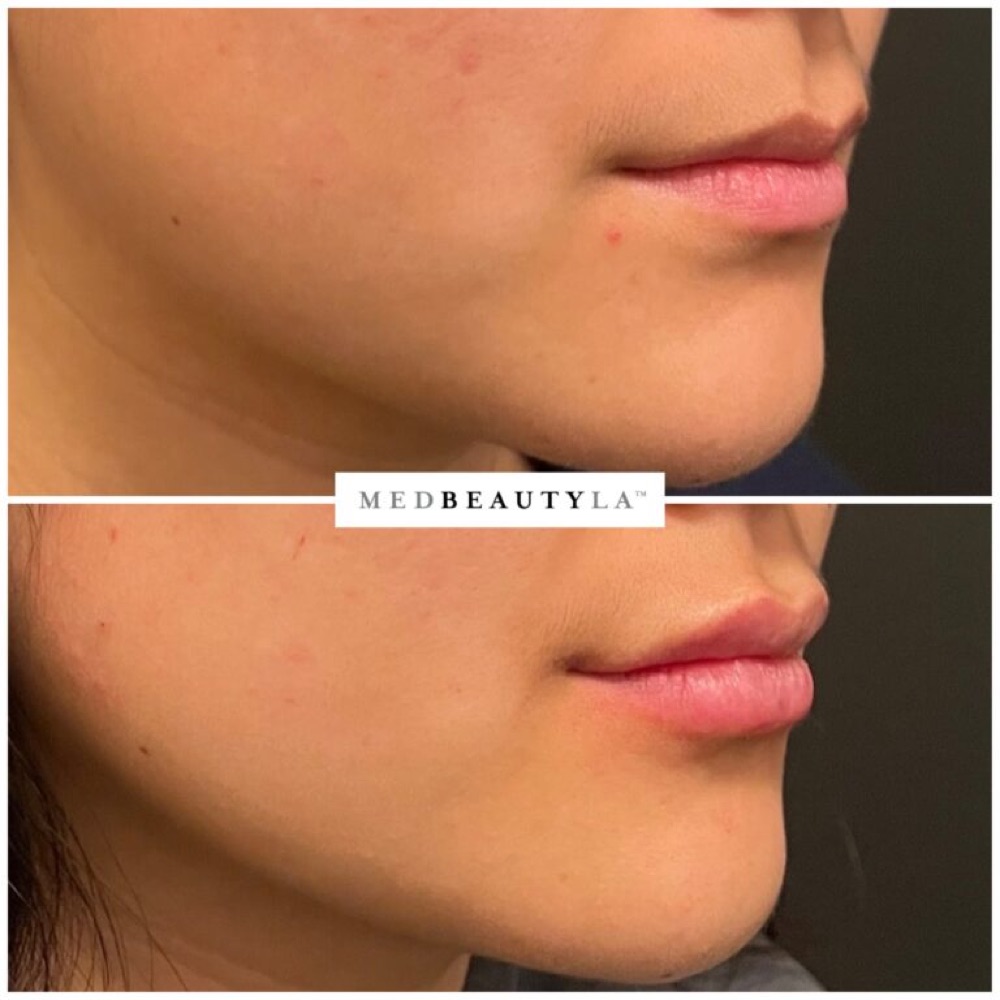 Lip filler before and after in profile: fuller lips in balance with the chin and nose