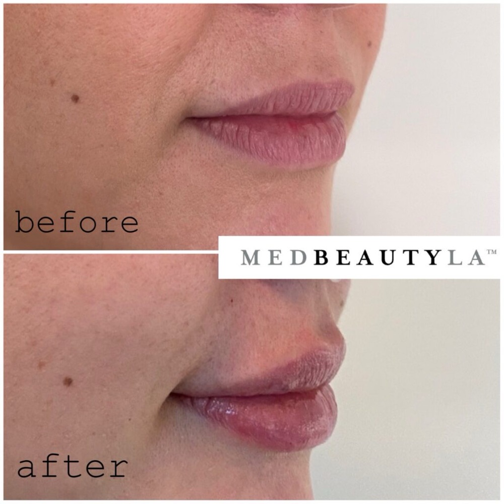 Lip filler before and after in profile: more projection and volume in the upper and lower lip