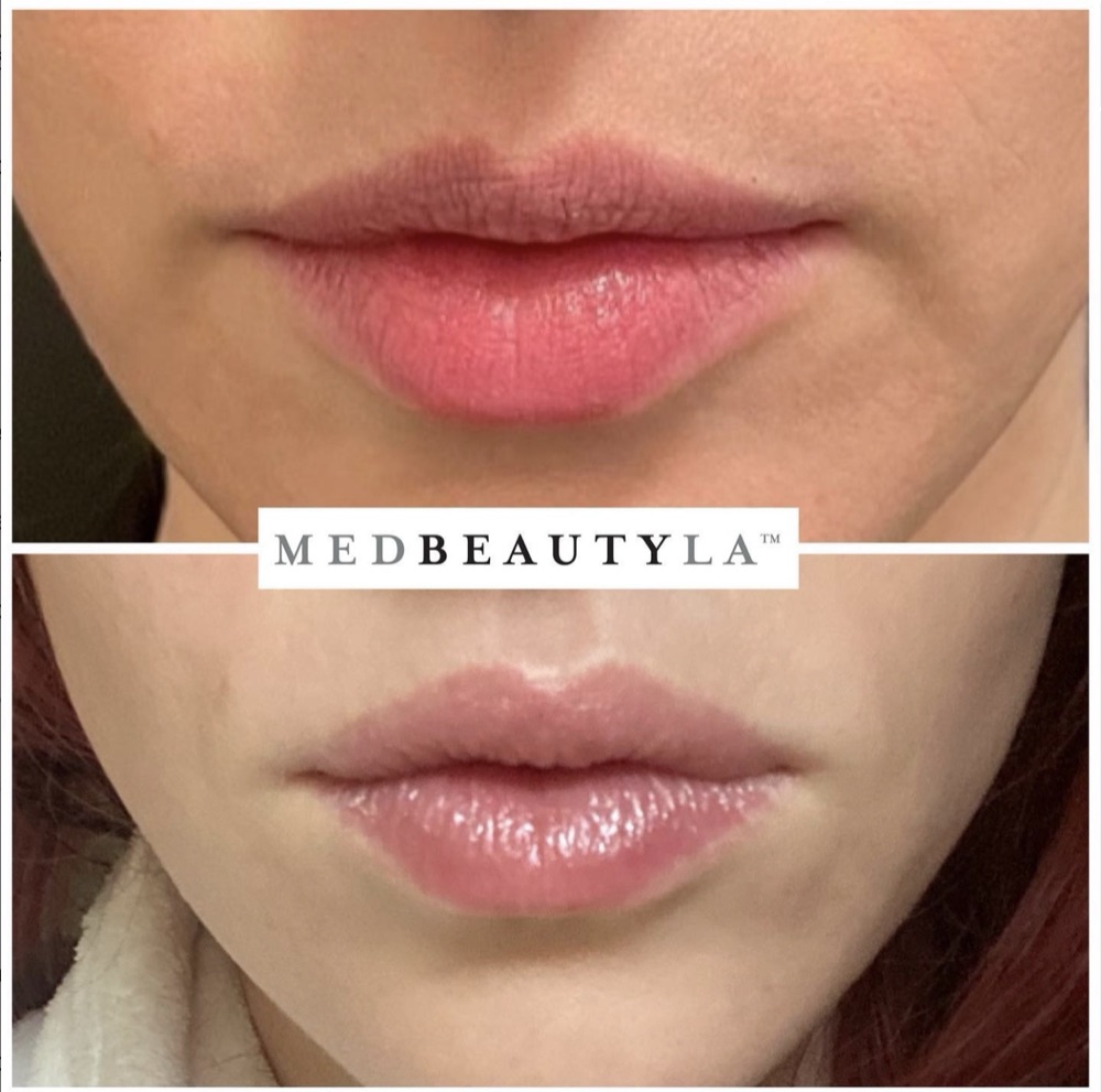 Botox lip flip before and after at MedBeautyLA: upper lip looks fuller without filler