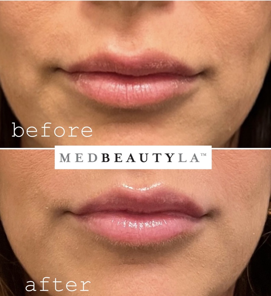LipLase laser lip plumping before and after at MedBeautyLA: a subtly fuller upper lip from the front