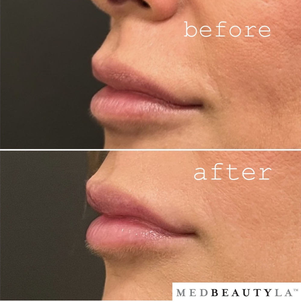 LipLase laser lip plumping before and after in profile: more projection and pout in the upper lip