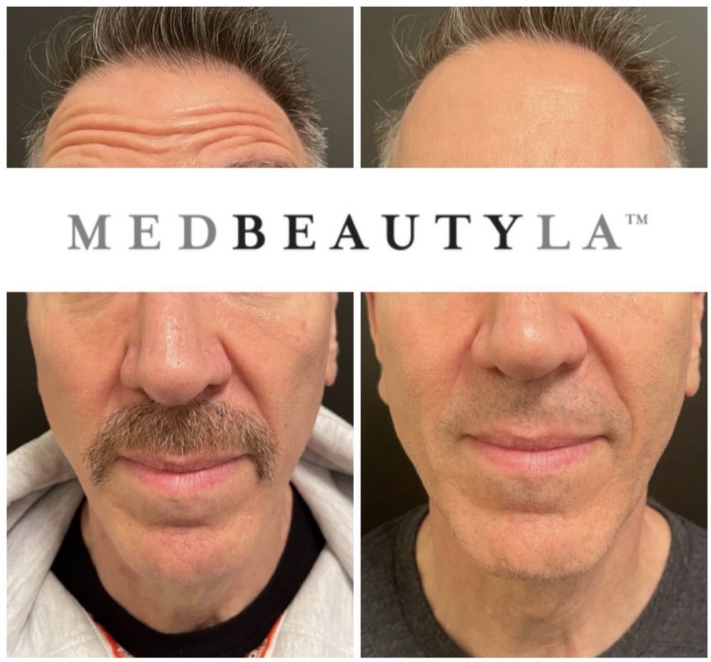 MedBeautyLA client before and after full-face rejuvenation with neuromodulators and filler: smoother forehead lines and softer folds around the mouth