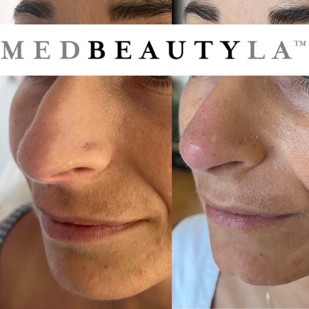 Non-surgical nose job before and after at MedBeautyLA, close-up of a smoother, more refined bridge and tip