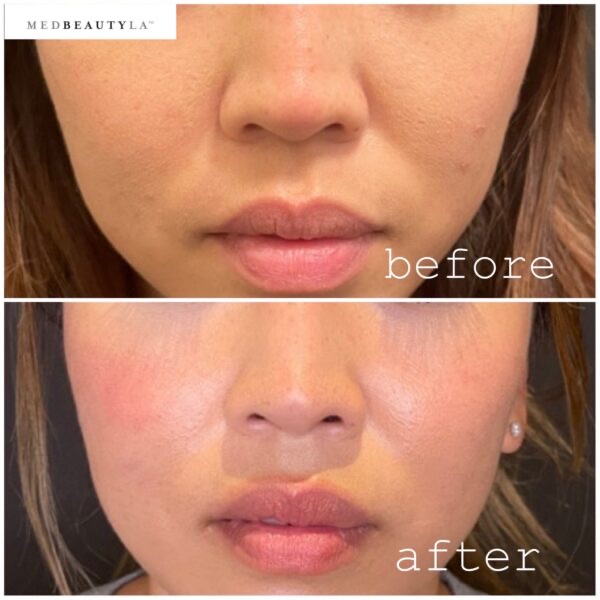 Nose filler before and after at MedBeautyLA, front view of a more refined nose