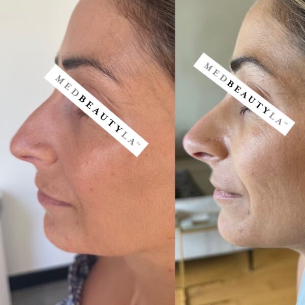 Non-surgical nose job before and after at MedBeautyLA, side profile with the bump on the bridge softened