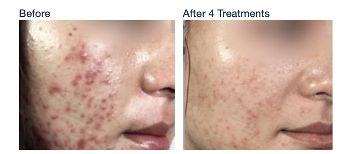 Before and after four IPL treatments for acne: inflamed red breakouts on the cheek greatly reduced