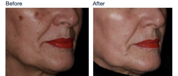 Before and after IPL plus ResurFX for sun damage: brown age spots on the cheek cleared