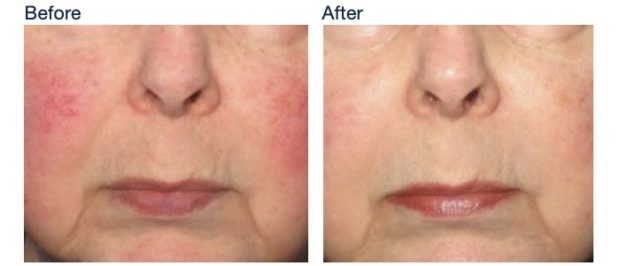 Before and after IPL for rosacea: diffuse redness on both cheeks visibly reduced