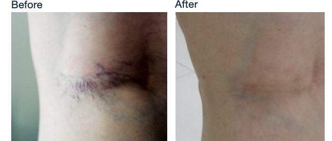 Before and after Nd:YAG laser for leg veins: purple spider veins behind the knee faded