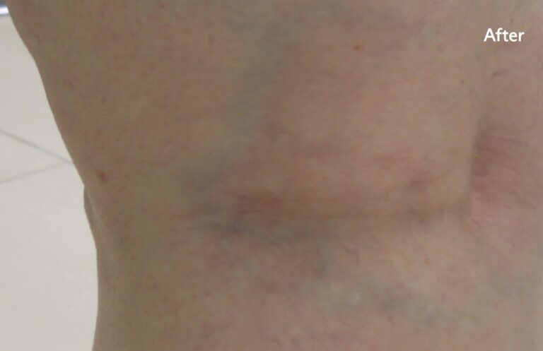 After laser treatment: the spider veins behind the knee have visibly faded