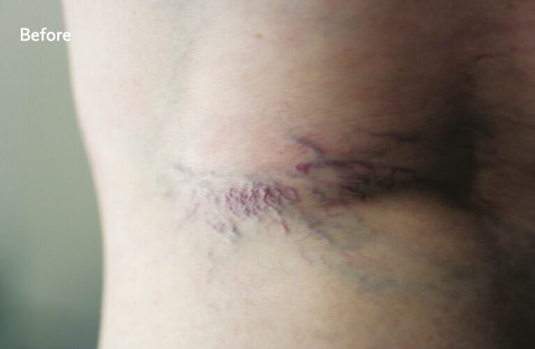 Before laser treatment: a cluster of red and purple spider veins behind the knee