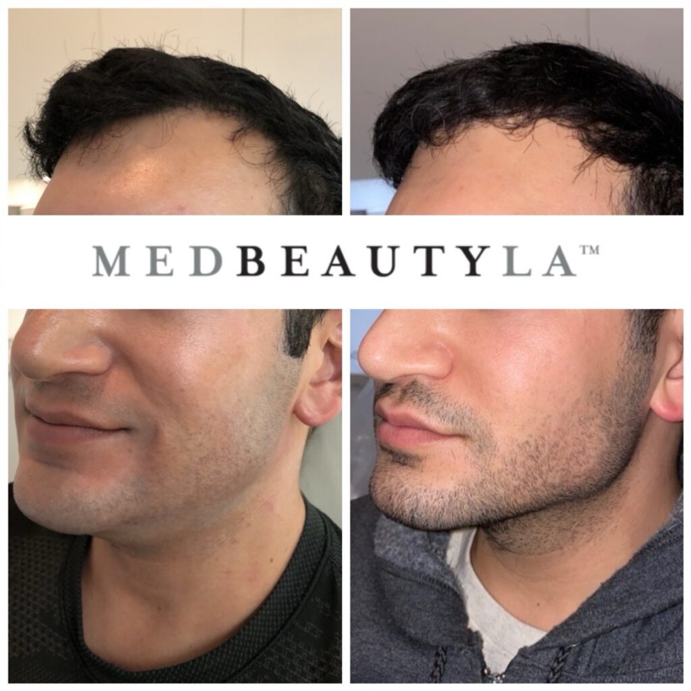 Male jawline enhancement before and after at MedBeautyLA: a softer jaw and chin made sharper and more defined from the side