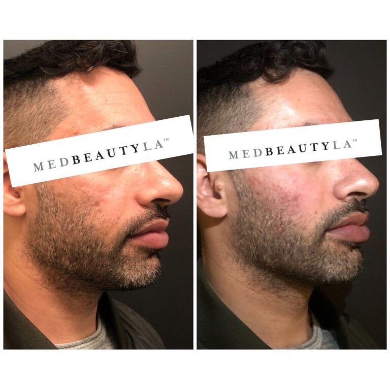 Male jawline enhancement before and after at MedBeautyLA: a bearded man's jawline more angular and defined in profile