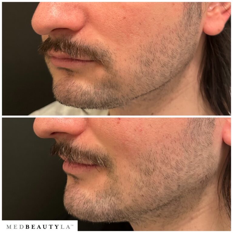 Male jawline enhancement before and after at MedBeautyLA: a stronger, straighter jawline from the side
