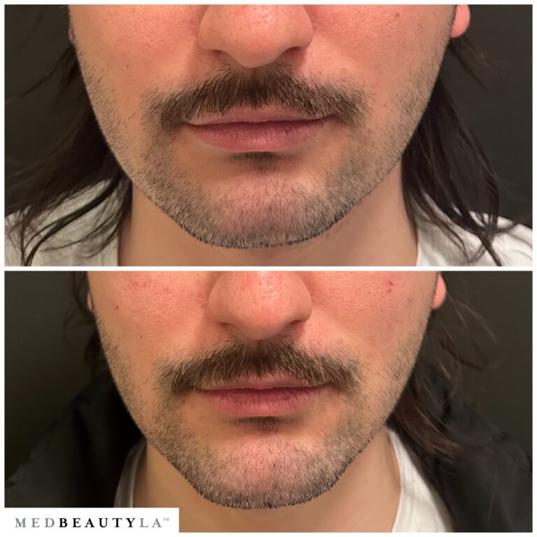 Male jawline enhancement before and after at MedBeautyLA: a broader, more defined chin and jaw from the front